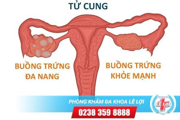 Đa Nang Buồng Trứng, Nguyên Nhân Và Cách Hỗ Trợ Điều Trị Hiệu Quả