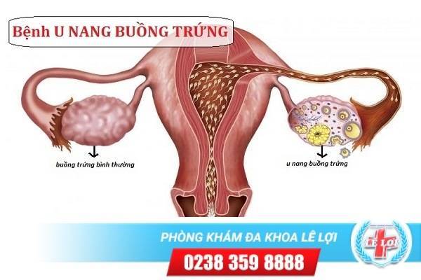 U Nang Buồng Trứng Là Gì? Triệu Chứng Và Cách Hỗ Trợ Điều Trị Hiệu Quả