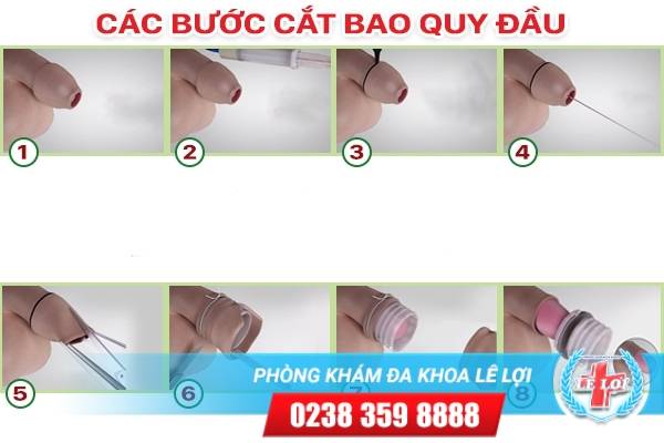 Đa Khoa Lê Lợi tiết lộ quy trình cắt bao quy đầu hiệu quả