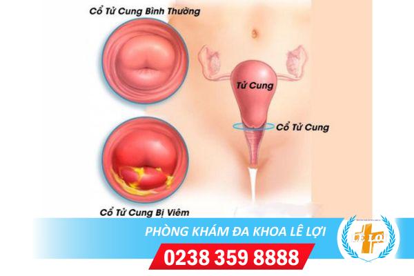 Những điều cần biết về bệnh viêm cổ tử cung