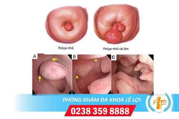 Polyp Cổ Tử Cung Là Căn Bệnh Như Thế Nào Và Những Điều Cần Chú Ý