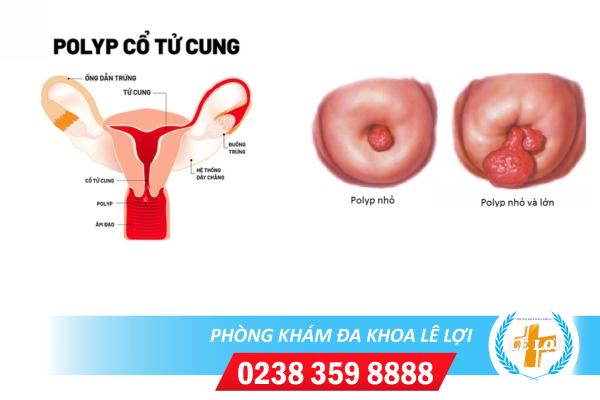 Biểu hiện nhận biết bệnh Polyp tử cung là gì và cách điều trị