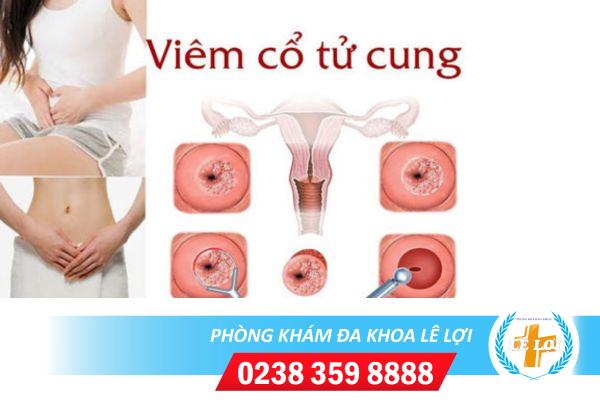 Viêm Cổ Tử Cung Và Cách Hỗ Trợ Chữa Trị Hiệu Quả