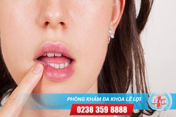 Phải làm gì khi bị sùi mào gà ở miệng