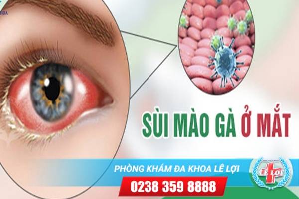 Bệnh sùi mào gà ở mắt