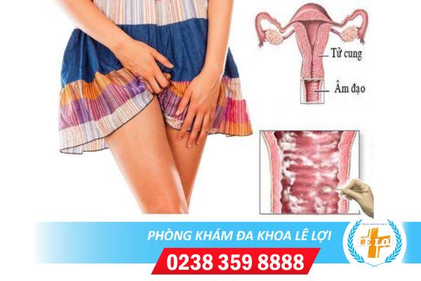 Ngứa âm đạo – dấu hiệu của bệnh lý nguy hiểm chị em cần biết