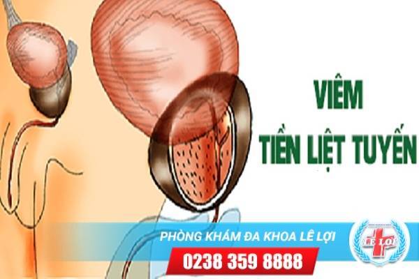 Viêm tiền liệt tuyến là bệnh gì ?