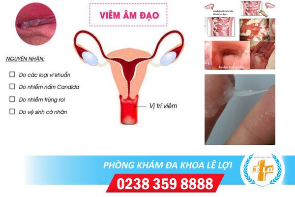 Biểu hiện của bệnh viêm âm đạo là như thế nào?