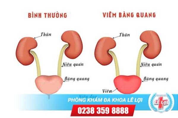 Triệu chứng của bệnh viêm bàng quang