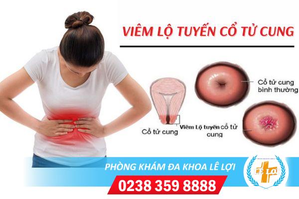 Viêm lộ tuyến cổ tử cung nguy hiểm như thế nào?