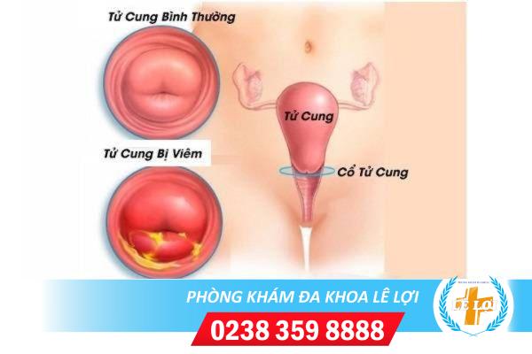 Những triệu chứng bệnh viêm tử cung chị em nên biết