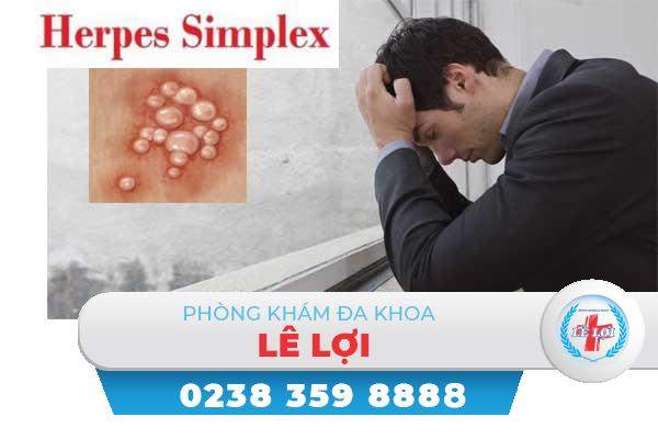 Herpes sinh dục là gì ?