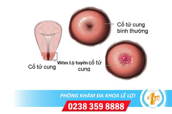 Phương pháp nào điều trị viêm lộ tuyến cổ tử cung hiệu quả?