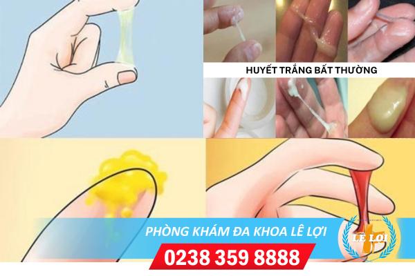 Cảnh giác với thay đổi màu sắc bất thường của huyết trắng phụ khoa