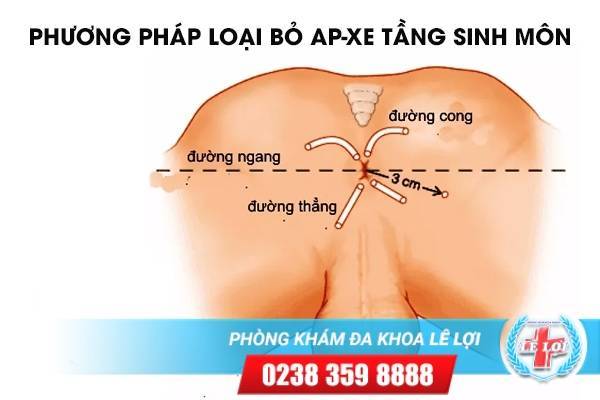 Phương pháp loại bỏ ap-xe tầng sinh môn – Liệu trình một lần duy nhất