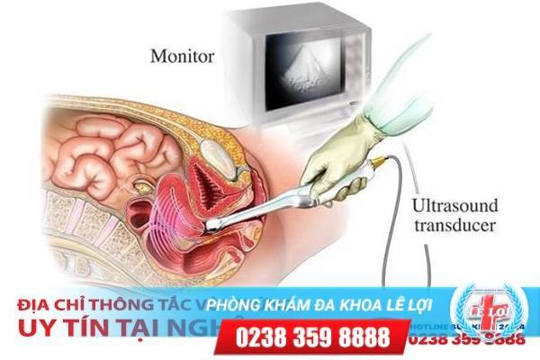 Địa chỉ thông tắc vòi trứng uy tín tại Nghệ An