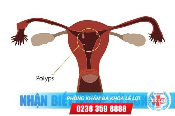 Polyp tử cung có thể nhận biết được không?