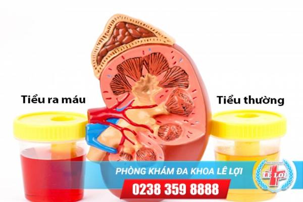 Đi tiểu ra máu là đang mắc bệnh gì?