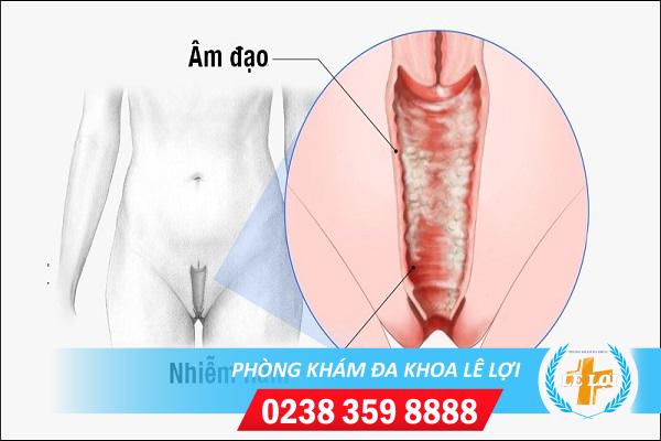 Nấm phụ khoa là gì? Triệu chứng các loại nấm phụ khoa