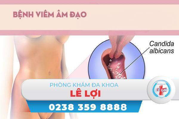 Bệnh viêm âm đạo gây nhiều phiền toái đối với sinh hoạt của chị em