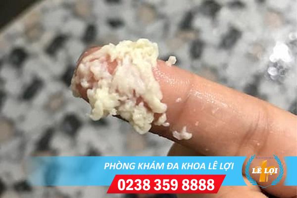 Mối nguy hiểm khó lường khi huyết trắng vón cục