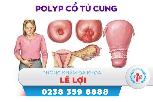 Polyp cổ tử cung là căn bệnh như thế nào, có nguy hiểm không?