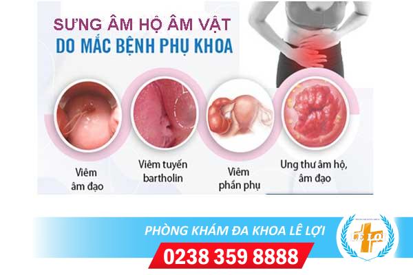 Sưng âm đạo – Triệu chứng bạn không nên xem thường