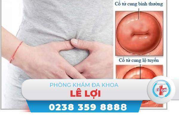 Sự nguy hiểm của căn bệnh Viêm Lộ Tuyến Cổ Tử Cung