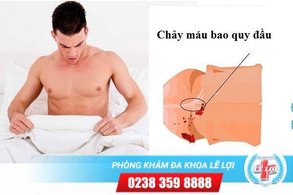 Chảy máu bao quy đầu là bị bệnh gì?