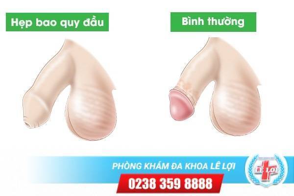 Các dấu hiệu hẹp bao quy đầu ở nam giới không nên chủ quan