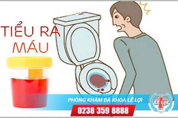 Đái ra máu – Cẩn thận với những bệnh lý nguy hiểm