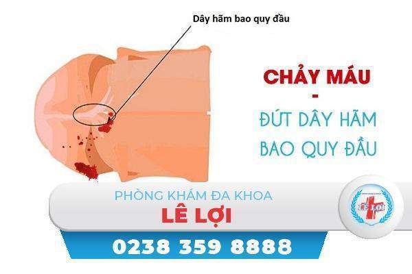 Đứt dây hãm bao quy đầu có sao không?