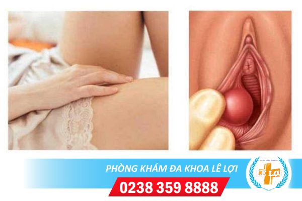 Nổi hạch âm đạo là bị bệnh gì có sao không?