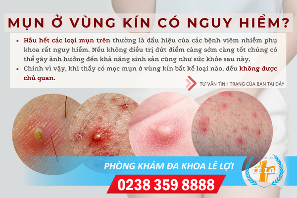 Giải đáp nguyên nhân hột le nổi mụn và cách chữa trị