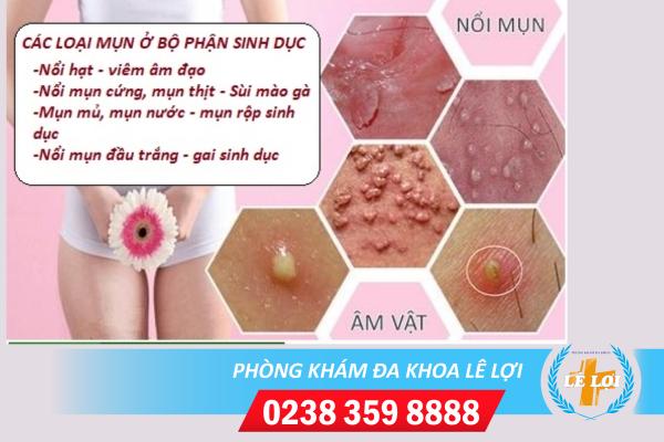 Nổi mụn âm đạo cảnh báo bệnh nguy hiểm gì?