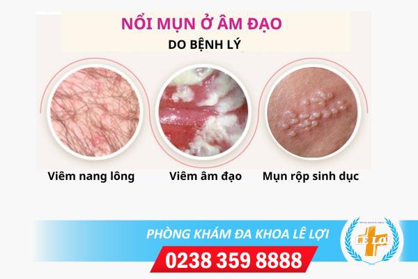 Nổi mẩn đỏ vùng kín – biểu hiện bệnh viêm phụ khoa nguy hiểm