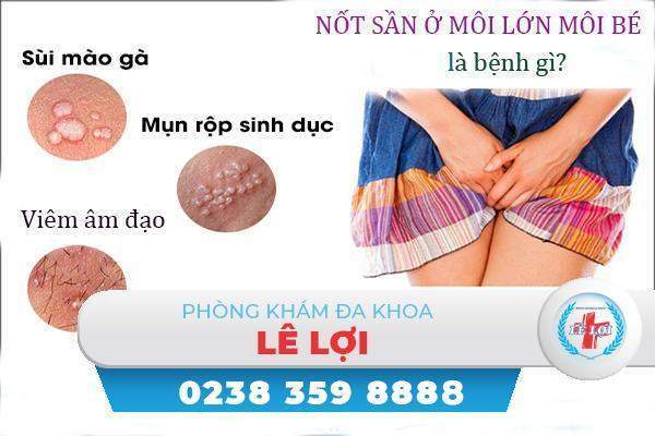 Nốt sần ở môi lớn môi bé nguy hiểm không?