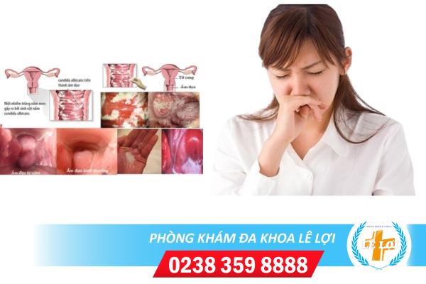 Phụ khoa bị hôi là dấu hiệu của bệnh gì?