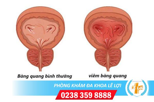 Nhận biết viêm bàng quang ở nữ và cách chữa trị tối ưu