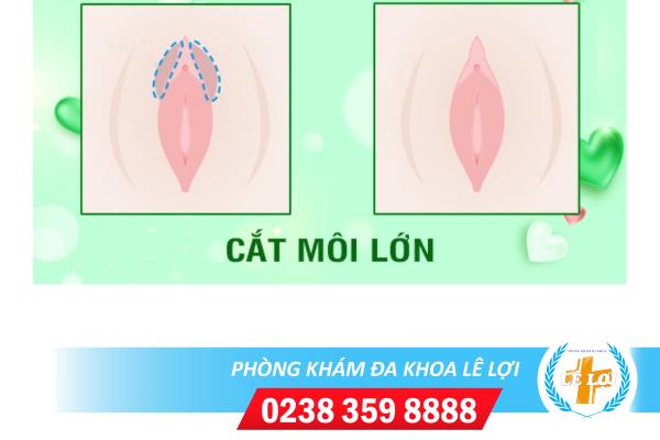 Cắt môi lớn ở đâu? có đắt không?