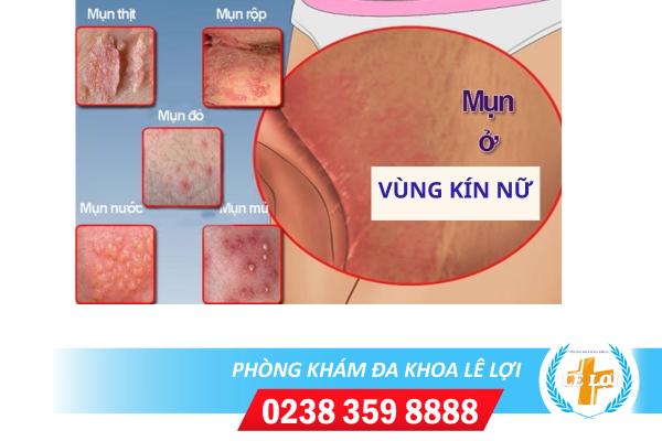 Cảnh giác với hiện tượng nổi mụn vùng kín