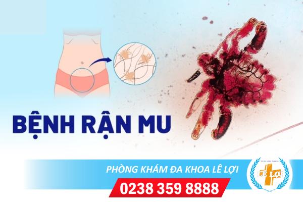 Rận mu là bệnh gì nguy hiểm không?