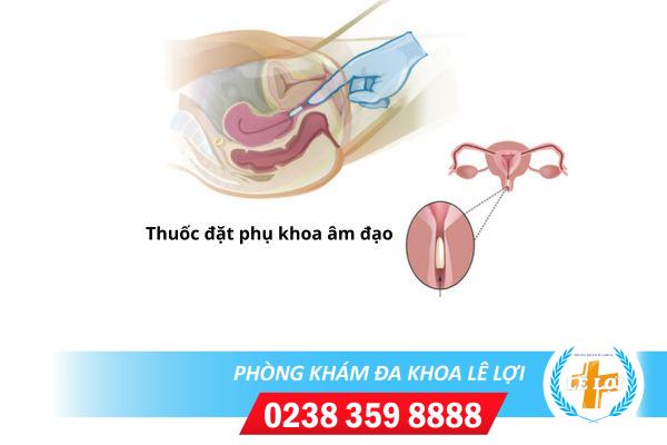 Những lưu ý khi dùng thuốc đặt phụ khoa âm đạo