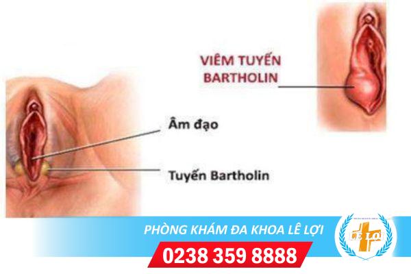 viem-tuyen-bartholin-co-nguy-hiem-khong-1