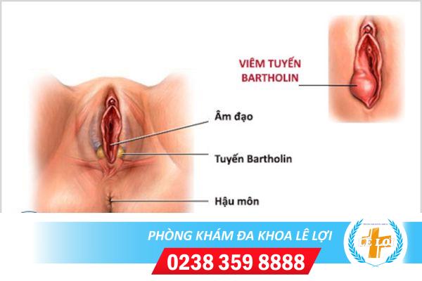 Nguyên nhân gây tuyến bartholin viêm do đâu?