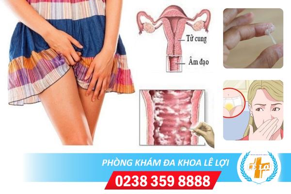 Chữa trị nấm vùng kín bằng cách nào hiệu quả?