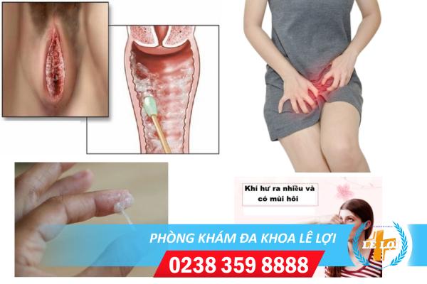 Cách chữa trị nấm phụ khoa hiệu quả