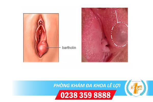 Sưng âm hộ âm vật là bị bệnh gì?