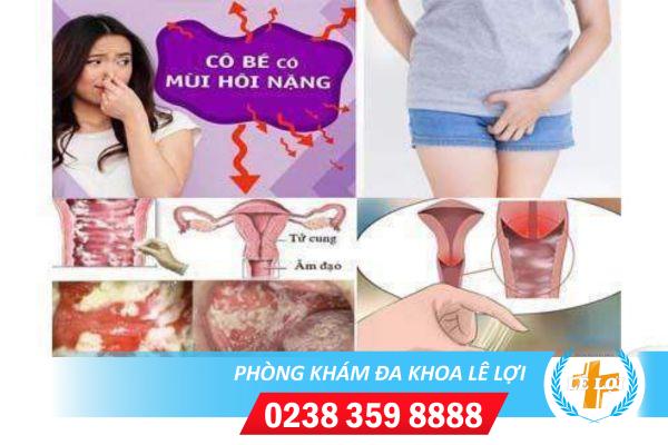 Viêm nhiễm âm đạo – dấu hiệu và cách chữa trị