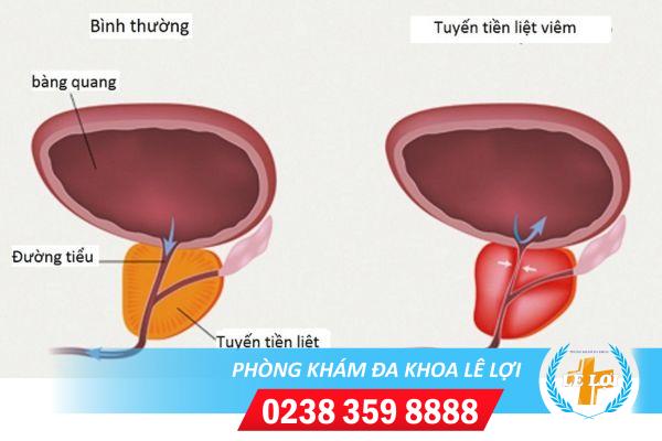 Nguyên nhân dấu hiệu cách điều trị viêm tuyến tiền liệt ở nữ